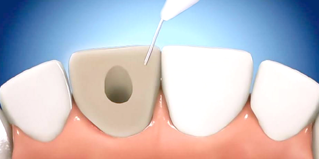 blanqueamiento dental interno, tratamientos del Dr Justo M Balaguer