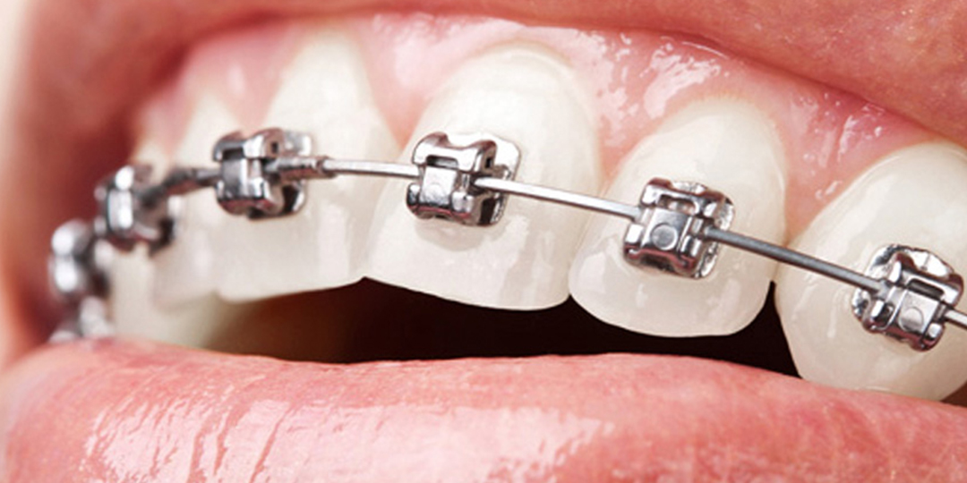 ortodoncia, tratamientos, Dr Justo M Balaguer